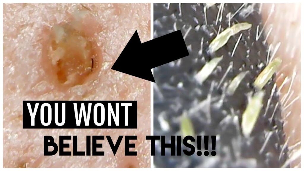 INSANE Blackhead Peel with MICROSCOPE!!! (you asked for it)